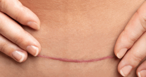 voorbeeld van een hypertrofisch litteken