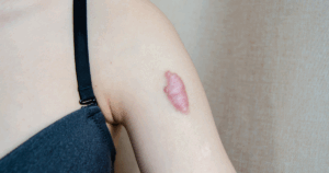 voorbeeld van een keloid litteken