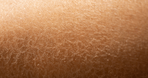 Een droge huid is de meest voorkomende oorzaak van jeuk op het lichaam