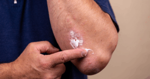 Mometasonfuroaat zalf is een geneesmiddel dat behoort tot de groep van de corticosteroïden: synthetische varianten van lichaamseigen bijnierschorshormonen die ontstekingen remmen