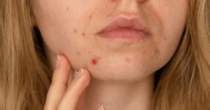 voorbeeld van een droge huid met puistjes